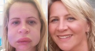 The lip has changed forever: a woman after a visit to the dentist does not recognize herself in the mirror (5 photos)