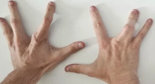 Genetic lottery: man born with four fingers on each hand (2 photos)