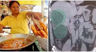 A Russian returned from the Philippines and discovered that he had worms from street food (3 photos)