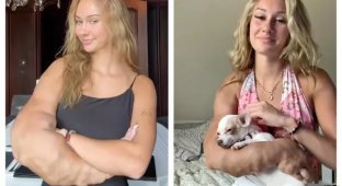 Сосудистый дефект стал причиной гигантского роста руки (2 фото + 2 видео)
