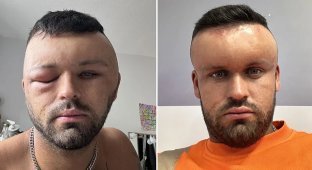 Like Megamind: the man's face was terribly swollen (6 photos)