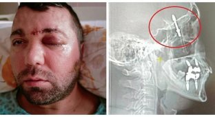 In Turkey, a dentist screwed a dental implant into a patient's brain cavity and escaped (8 photos)