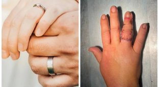 A Russian woman tore off her finger with a wedding ring (2 photos)