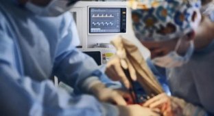 Unique Surgery: Man Removes Giant "Devil's Horn" (3 photos)