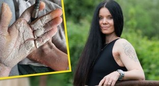 A woman with fish scale disease needs to apply 10 kg of cream to herself (5 photos)