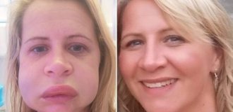 The lip has changed forever: a woman after a visit to the dentist does not recognize herself in the mirror (5 photos)