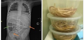 Напоминание не пить сырую воду: кадры извлечения из тела пациента гигантских червей (5 фото)