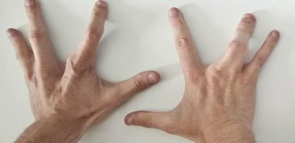 Genetic lottery: man born with four fingers on each hand (2 photos)