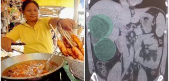 A Russian returned from the Philippines and discovered that he had worms from street food (3 photos)