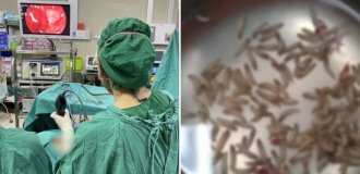 A resident of Thailand found hundreds of larvae in her nose (5 photos)