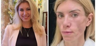 Plastic Surgeon Who Disfigured Model in Sochi Cleared of Responsibility (4 Photos)