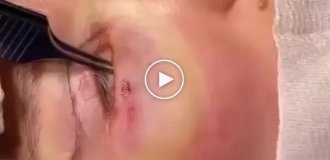 Removing bags under the eyes