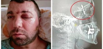 In Turkey, a dentist screwed a dental implant into a patient's brain cavity and escaped (8 photos)