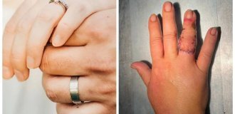 A Russian woman tore off her finger with a wedding ring (2 photos)