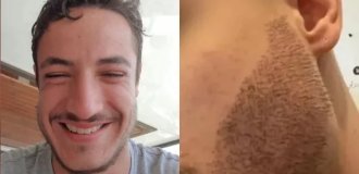 French student commits suicide after unsuccessful beard hair transplant (4 photos)