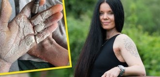 A woman with fish scale disease needs to apply 10 kg of cream to herself (5 photos)