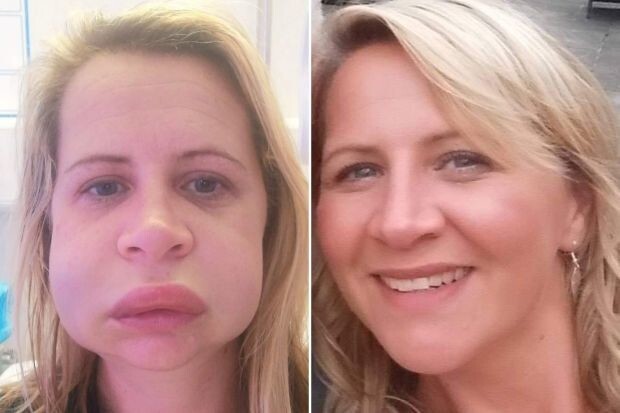 The lip has changed forever: a woman after a visit to the dentist does not recognize herself in the mirror (5 photos)