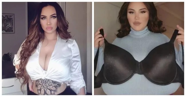 A woman spoke about her struggle with size 18 breasts, which do not stop growing due to a rare disease (5 photos)