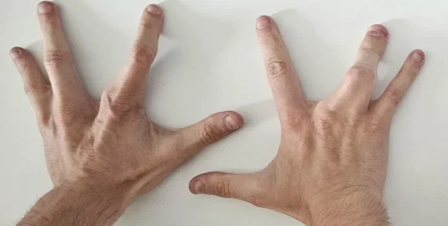 Genetic lottery: man born with four fingers on each hand (2 photos)