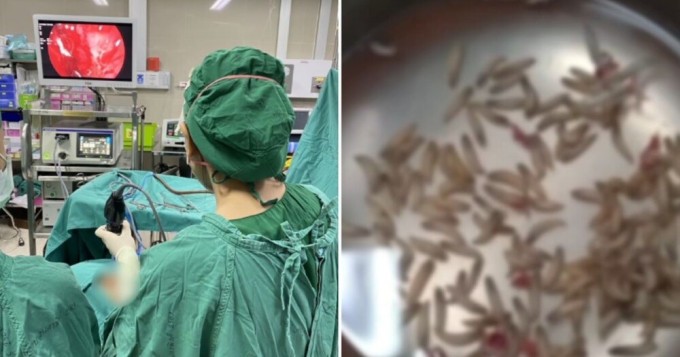 A resident of Thailand found hundreds of larvae in her nose (5 photos)