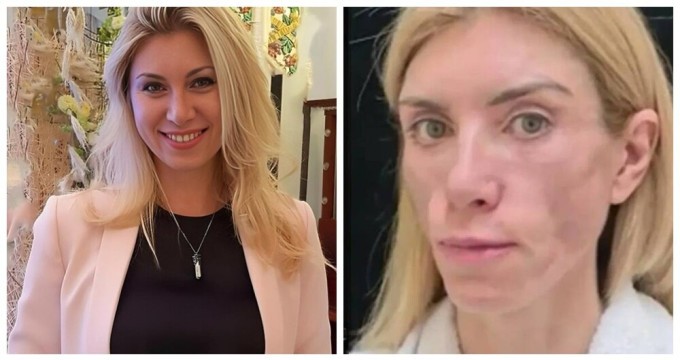 Plastic Surgeon Who Disfigured Model in Sochi Cleared of Responsibility (4 Photos)