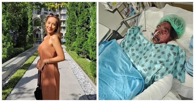 A Thai model lost the ability to walk and went blind in one eye after taking a well-known antibiotic (6 photos + 1 video)