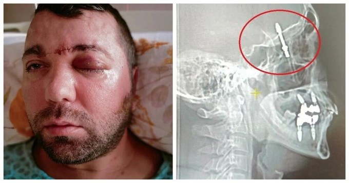 In Turkey, a dentist screwed a dental implant into a patient's brain cavity and escaped (8 photos)