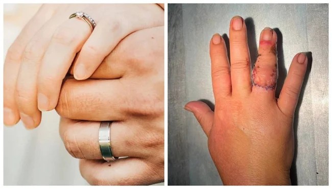 A Russian woman tore off her finger with a wedding ring (2 photos)