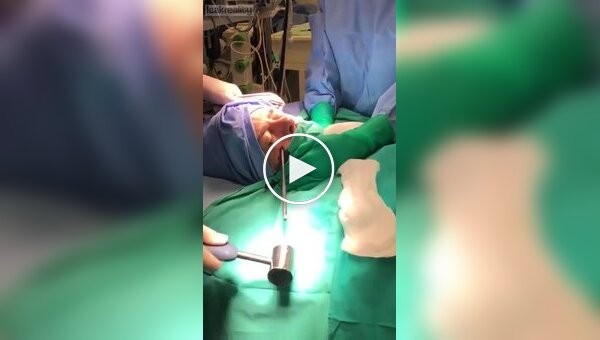 Doctors removed a splinter from the head.