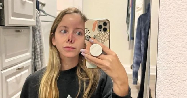 Женщине потребовалось 16 операций, чтобы восстановить нос после укуса собаки (6 фото + 2 видео)