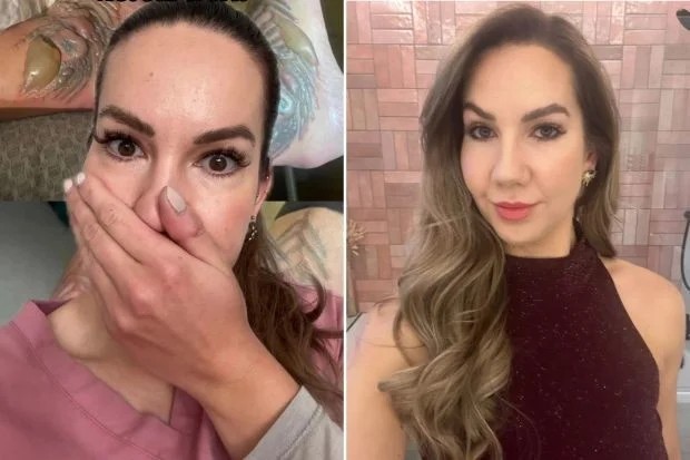 Женщина не могла носить обувь несколько месяцев после неудачного удаления татуировки (4 фото)