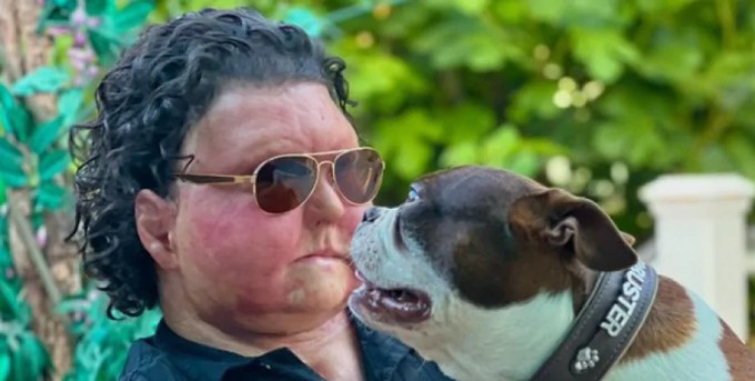 A man after a face transplant showed whether his own dogs recognized him (3 photos + 1 video)