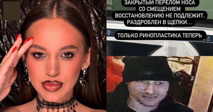 In Russia, a man who was not allowed into a bar broke a girl’s nose out of resentment and ran away (2 photos + 2 videos)