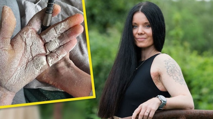 A woman with fish scale disease needs to apply 10 kg of cream to herself (5 photos)